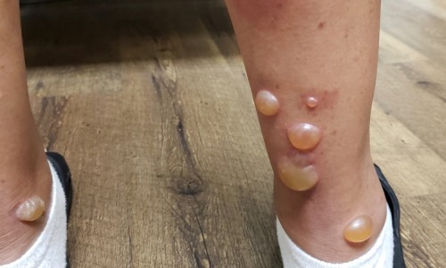哺乳期能不能用甲硝唑片-哺乳期能用甲硝唑片塞阴道里吗网 - 网站提供哺乳期可以用甲硝唑栓剂治疗妇科病吗小常识、甲硝唑栓哺乳期可以用吗写的禁用